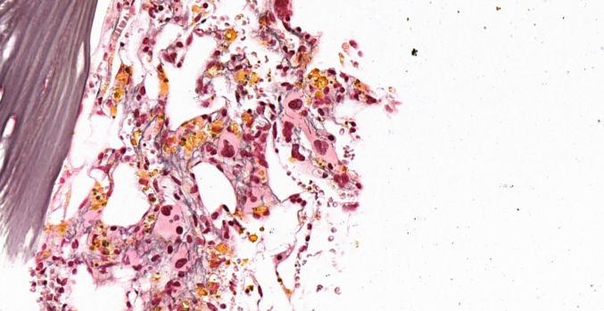 Photo shows Dysplastic megakaryocytes in the bone marrow of the patient suffering from MDS