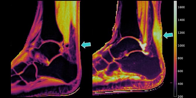 In vivo quantitative MRI scans reveal swelling-associated changes when comparing a healthy participant (left) with a patient diagnosed with mid-portion Achilles tendinopathy (right).
